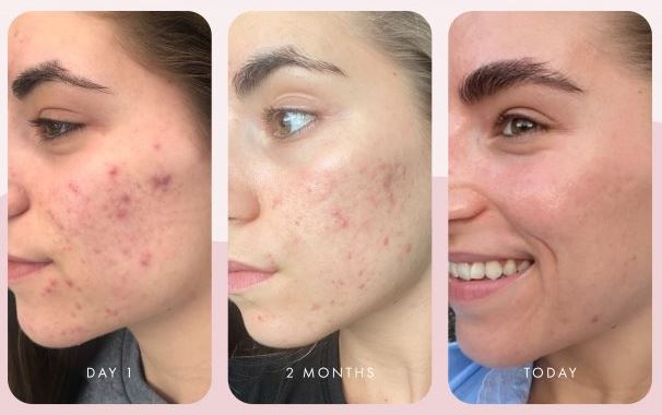 How to create a skincare routine for acne-prone skin