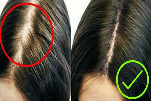 Natural Remedies for Hair Thinning and Hair Loss