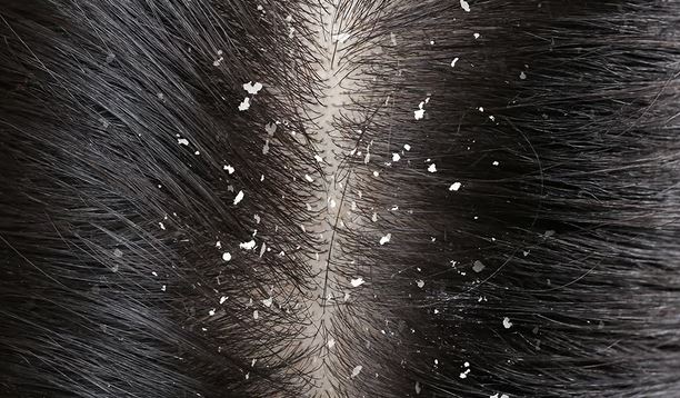  Natural Remedies for Dandruff: Say Goodbye to Flakes