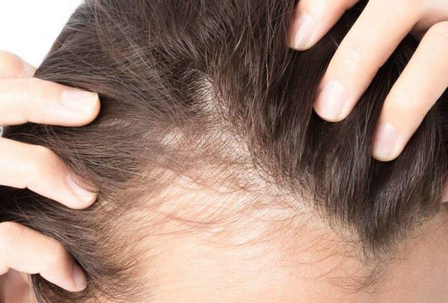 The Science Behind Hair Loss: Causes and Solutions