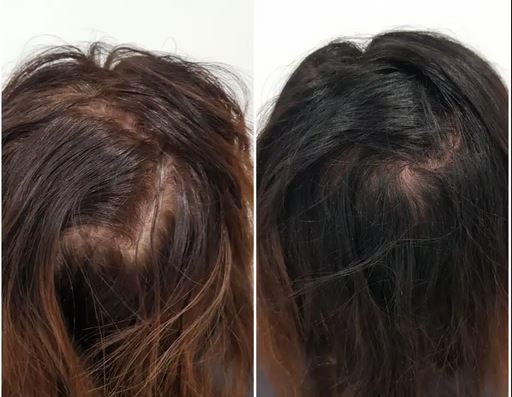  The Science Behind Hair Density: Understanding Your Hair's Thickness